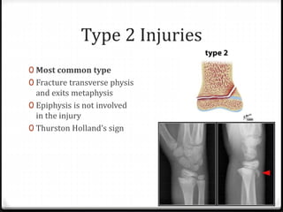 Type 2 Injuries
0 Most common type
0 Fracture transverse physis
and exits metaphysis
0 Epiphysis is not involved
in the injury
0 Thurston Holland’s sign
 