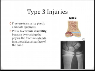 Type 3 Injuries
0 Fracture transverse physis
and exits epiphysis
0 Prone to chronic disability,
because by crossing the
physis, the fracture extends
into the articular surface of
the bone
 