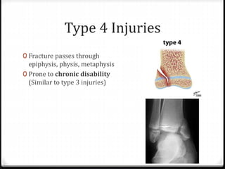 Type 4 Injuries
0 Fracture passes through
epiphysis, physis, metaphysis
0 Prone to chronic disability
(Similar to type 3 injuries)
 