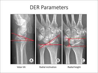 DER	Parameters	
Radial	inclinationVolar	tilt Radial	height
 