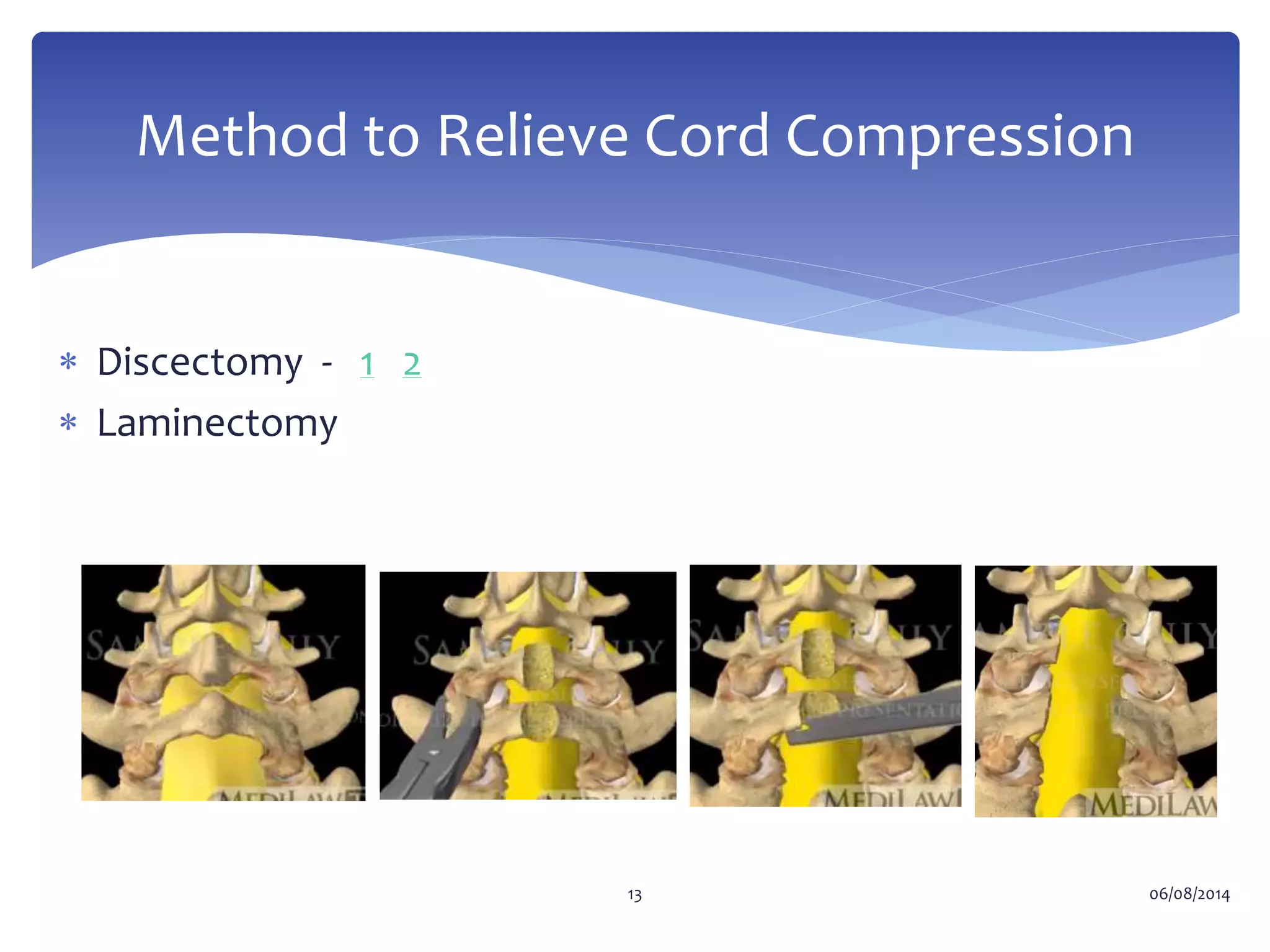 Conus medullaris and cauda equina syndrome | PPTX