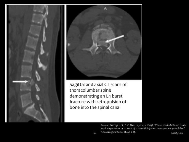 Conus medullaris and cauda equina syndrome