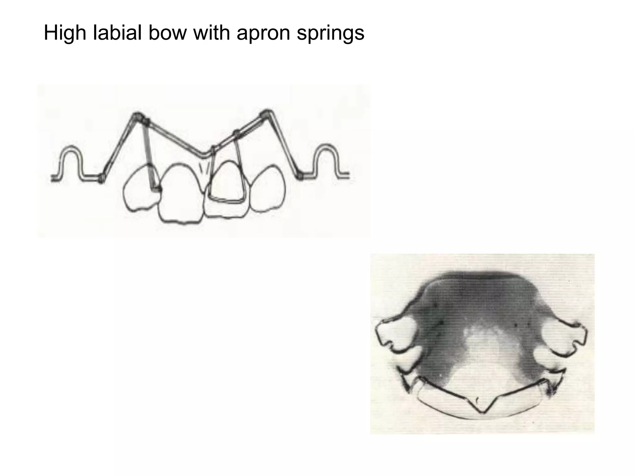 orthodontic-appliance-pptx