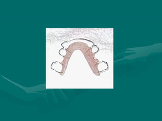 Rickinator Orthodontic Appliance | PPTX