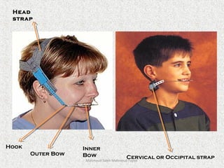 Head
strap
Cervical or Occipital strap
Hook
Outer Bow
Inner
Bow
Mahmoud Saleh Mahmoud Fayed
 