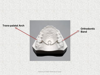 Mahmoud Saleh Mahmoud Fayed
Trans-palatal Arch
Orthodontic
Band
 