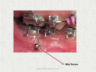 Mahmoud Saleh Mahmoud Fayed
Mini Screw
 