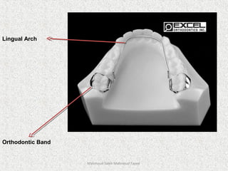 Mahmoud Saleh Mahmoud Fayed
Orthodontic Band
Lingual Arch
 