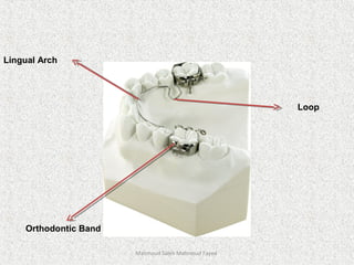 Mahmoud Saleh Mahmoud Fayed
Lingual Arch
Orthodontic Band
Loop
 