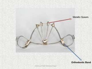 Mahmoud Saleh Mahmoud Fayed
Metallic Spears
Orthodontic Band
 