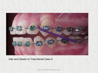 Mahmoud Saleh Mahmoud Fayed
Inter arch Elastic to Treat Dental Class II
 