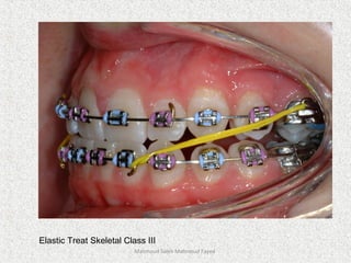 Mahmoud Saleh Mahmoud Fayed
Elastic Treat Skeletal Class III
 