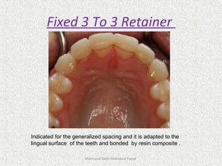 Fixed 3 To 3 Retainer
Mahmoud Saleh Mahmoud Fayed
Indicated for the generalized spacing and it is adapted to the
lingual surface of the teeth and bonded by resin composite .
 