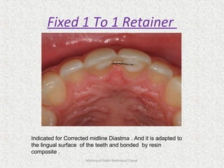 Mahmoud Saleh Mahmoud Fayed
Fixed 1 To 1 Retainer
Indicated for Corrected midline Diastma . And it is adapted to
the lingual surface of the teeth and bonded by resin
composite .
 