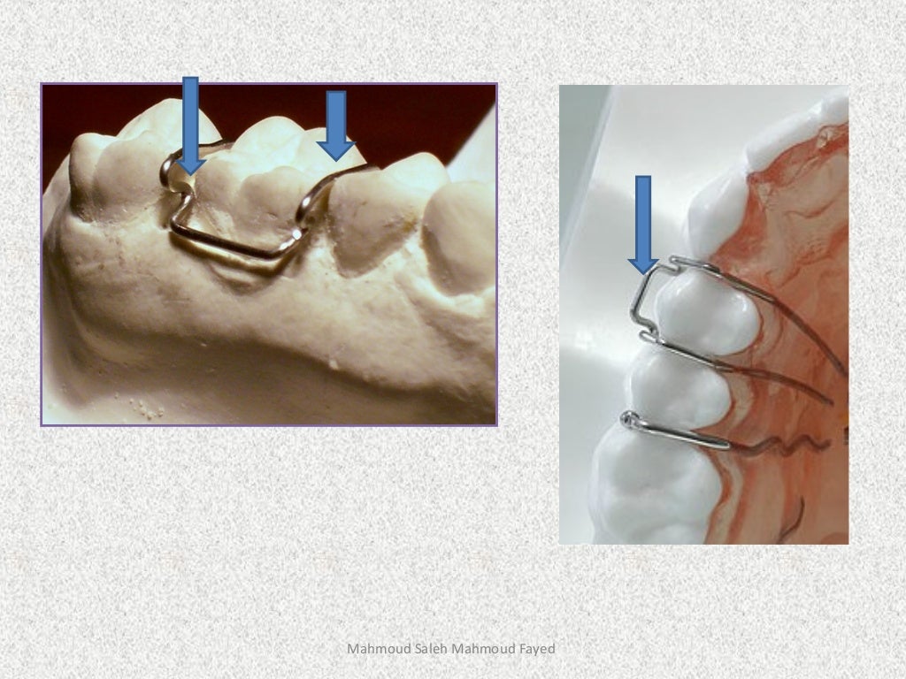Orthodontic appliances