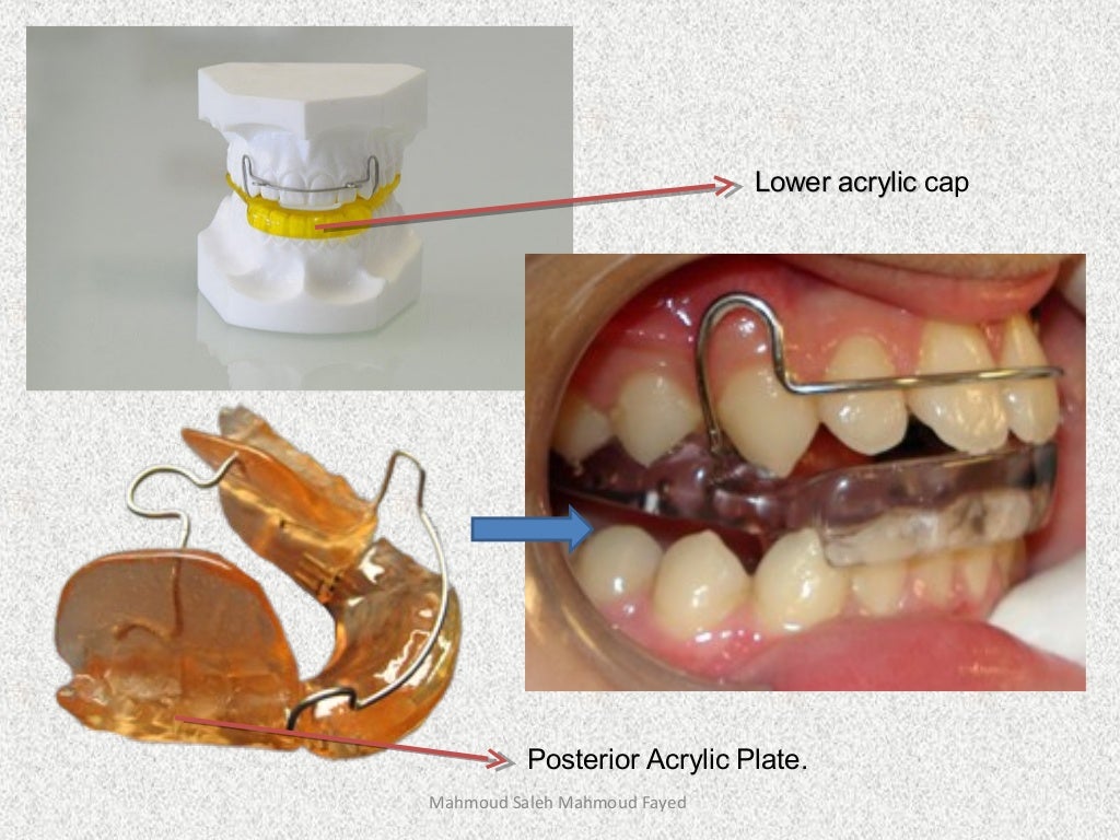 Orthodontic appliances
