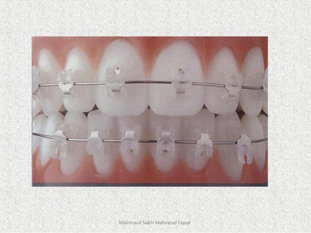 orthodontic appliances