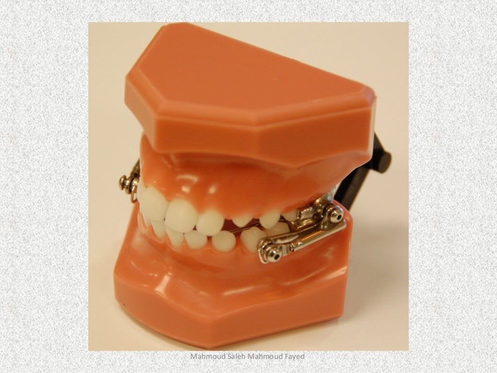 Orthodontic appliances