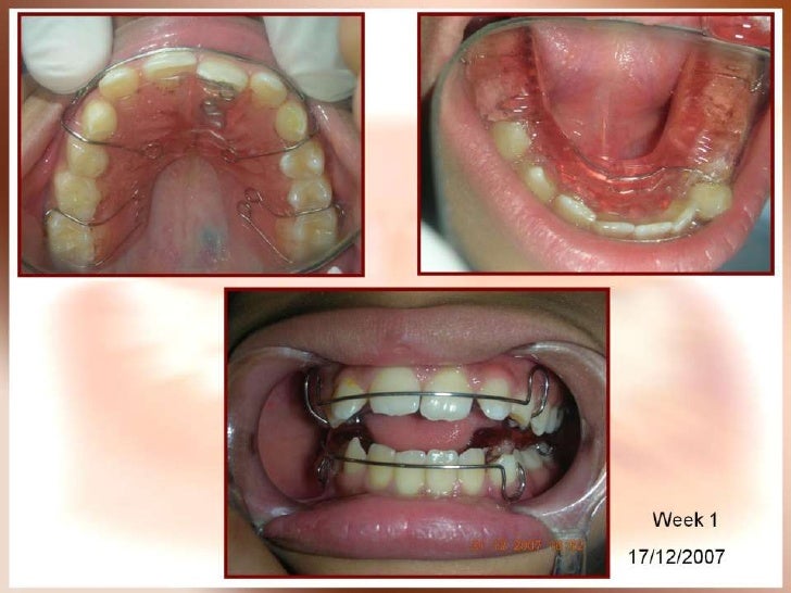 Orthodontic case presentation