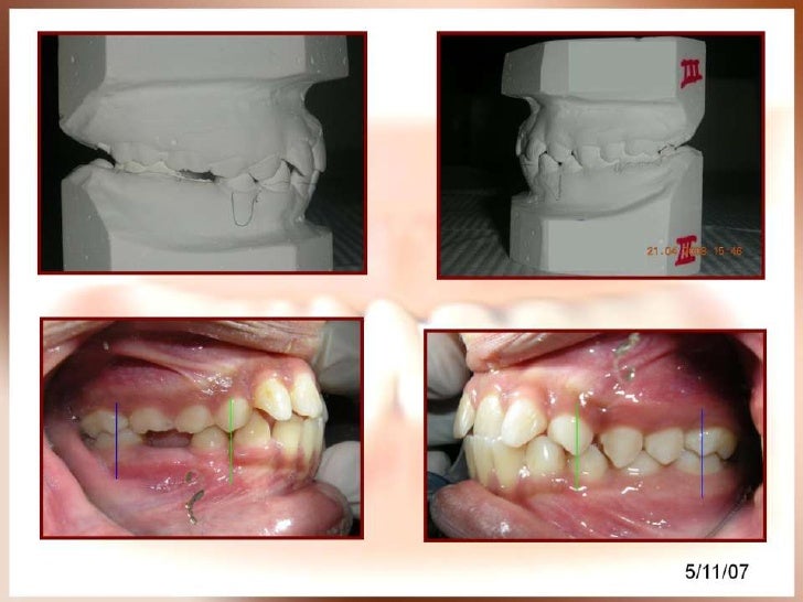 Orthodontic case presentation