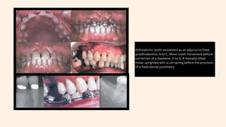 Orthodontic tooth movement as an adjunct to fixed
prosthodontics. A to C, Minor tooth movement before
correction of a diastema. D to G, A mesially tilted
molar uprighted with a coil spring before the provision
of a fixed dental prosthesis.
 