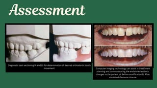 Diagnostic cast sectioning (A and B) for determination of desired orthodontic tooth
movement Computer imaging technology can assist in treat?ment
planning and communicating the envisioned esthetic
changes to the patient. A, Before modification B, After
simulated diastema closure.
 
