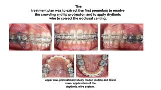 Protursion Wire Orthodontic correction of occlusal plane canting part 1 | PPTX