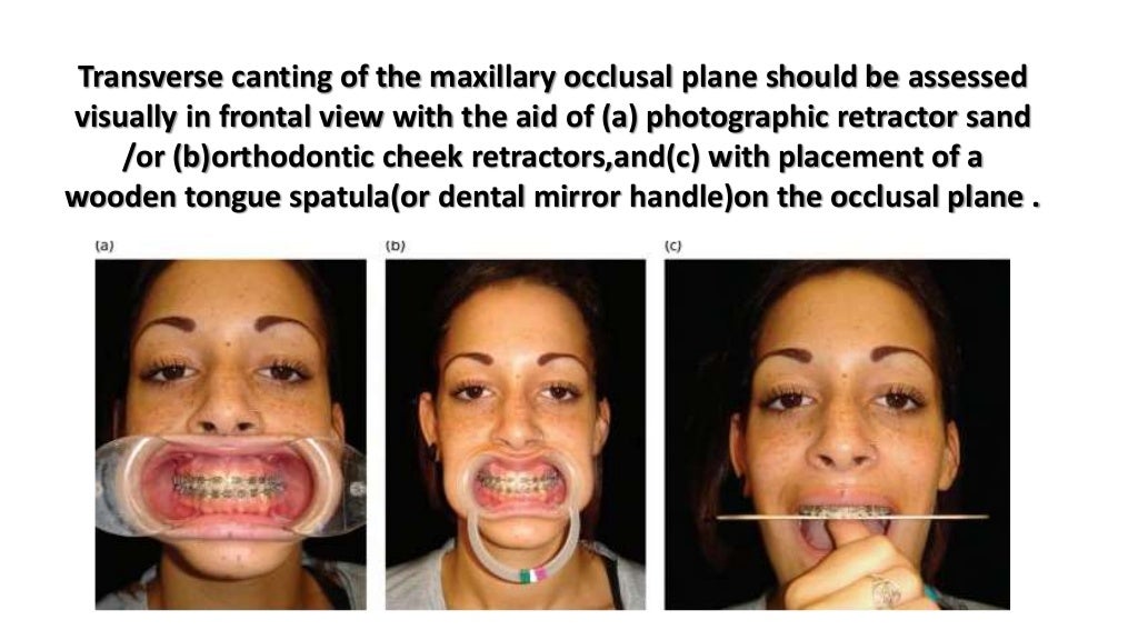 Orthodontic correction of occlusal plane canting part 1