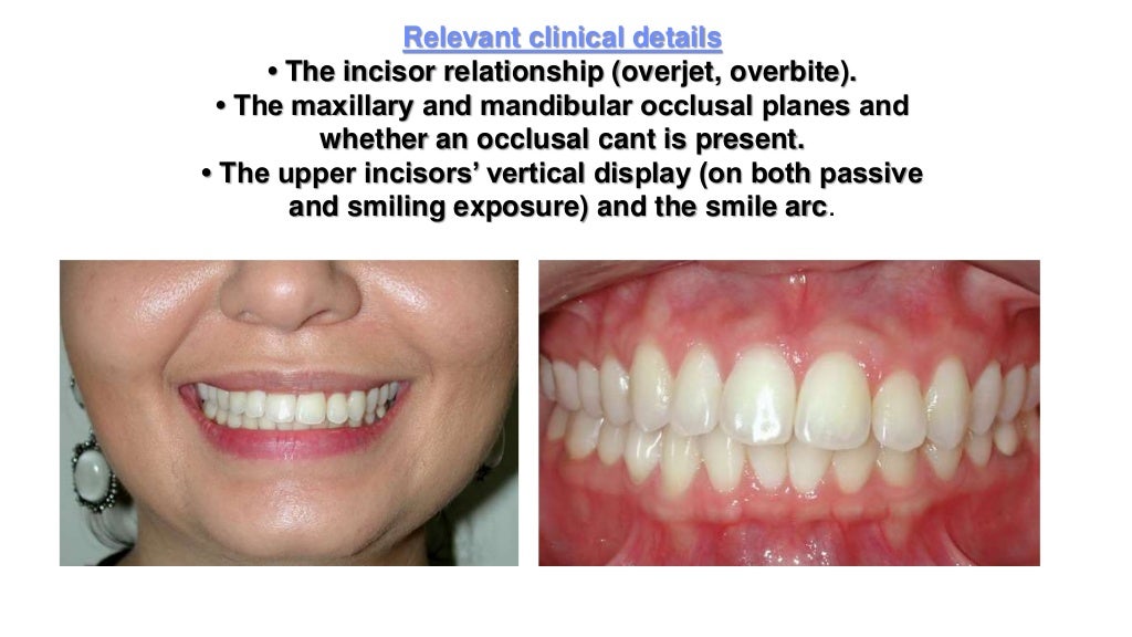 Orthodontic correction of occlusal plane canting part 1