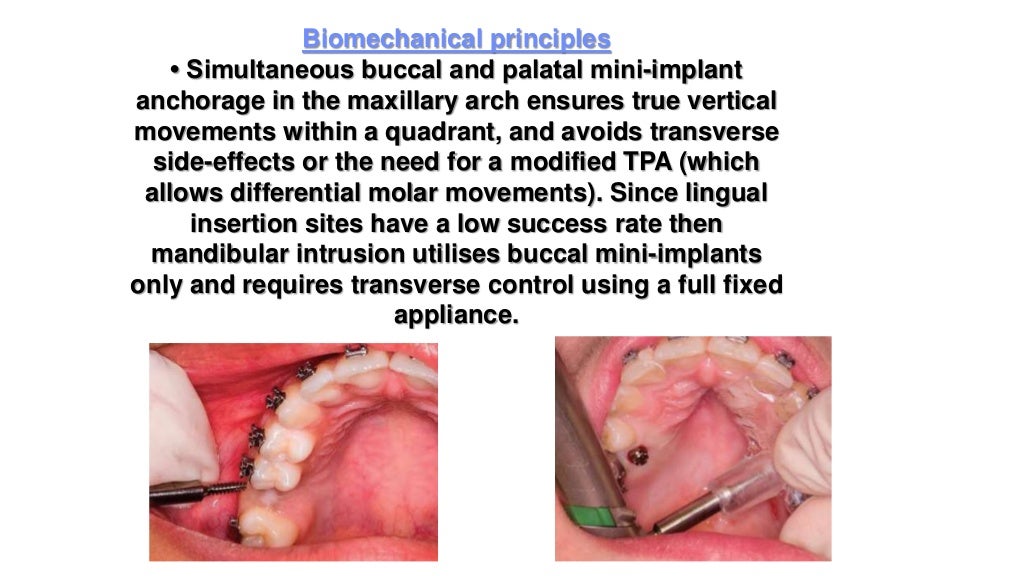 Orthodontic correction of occlusal plane canting part 1