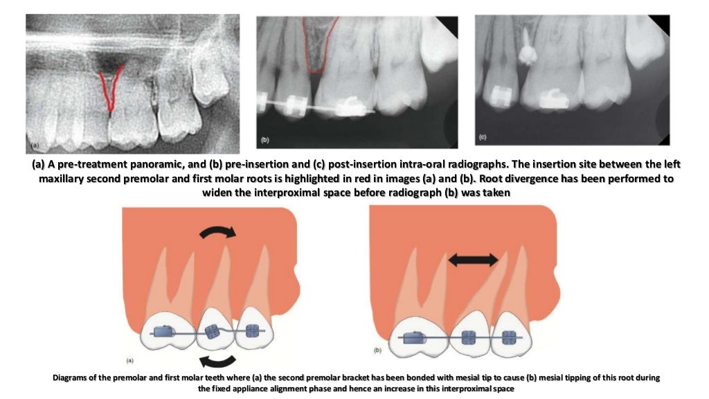 Orthodontic correction of occlusal plane canting part 1