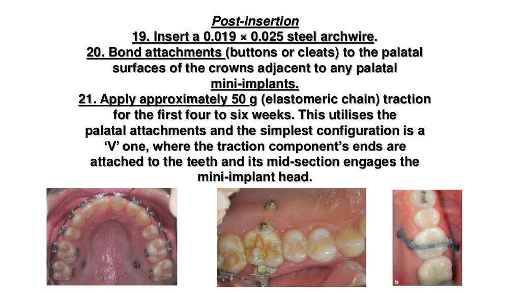 Orthodontic correction of occlusal plane canting part 1
