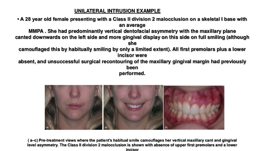 Orthodontic correction of occlusal plane canting part 1