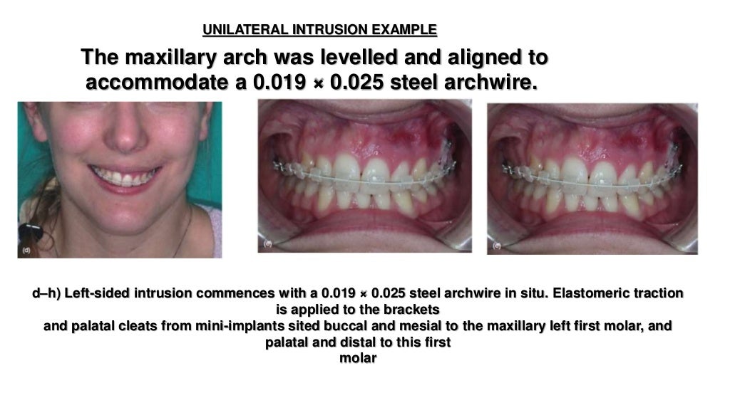 Orthodontic correction of occlusal plane canting part 1