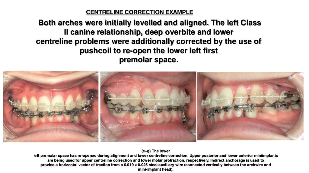 Orthodontic correction of occlusal plane canting part 1