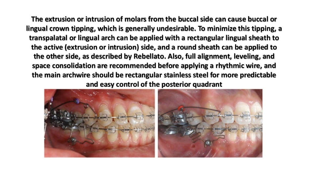 Orthodontic correction of occlusal plane canting part 1