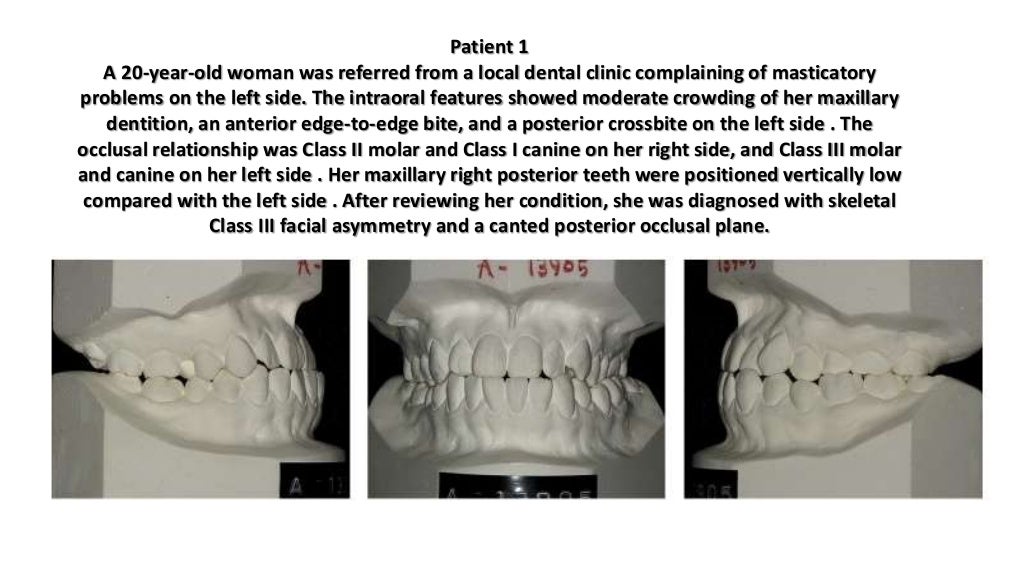 Orthodontic correction of occlusal plane canting part 1