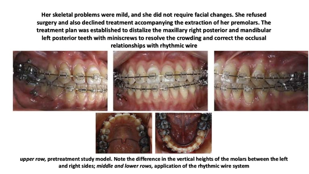 Orthodontic correction of occlusal plane canting part 1