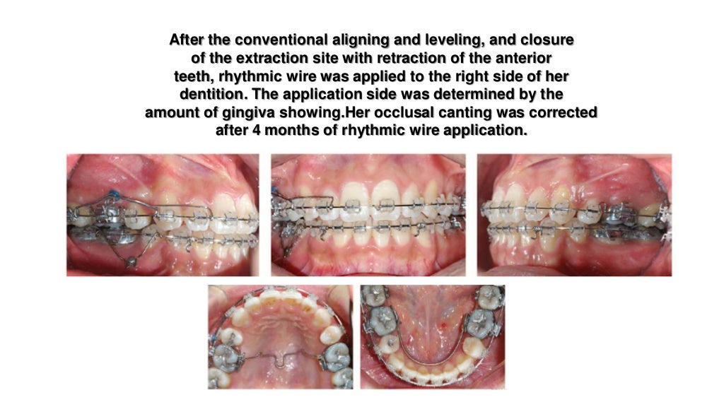 Orthodontic correction of occlusal plane canting part 1