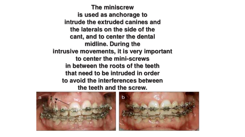 Orthodontic correction of occlusal plane canting part 1