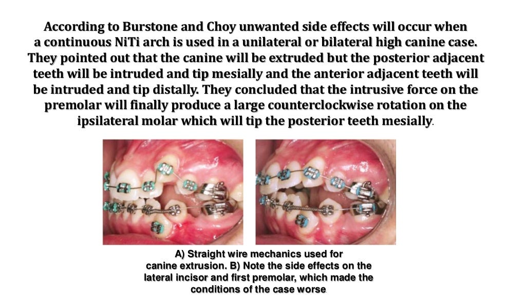 Orthodontic correction of occlusal plane canting part 1