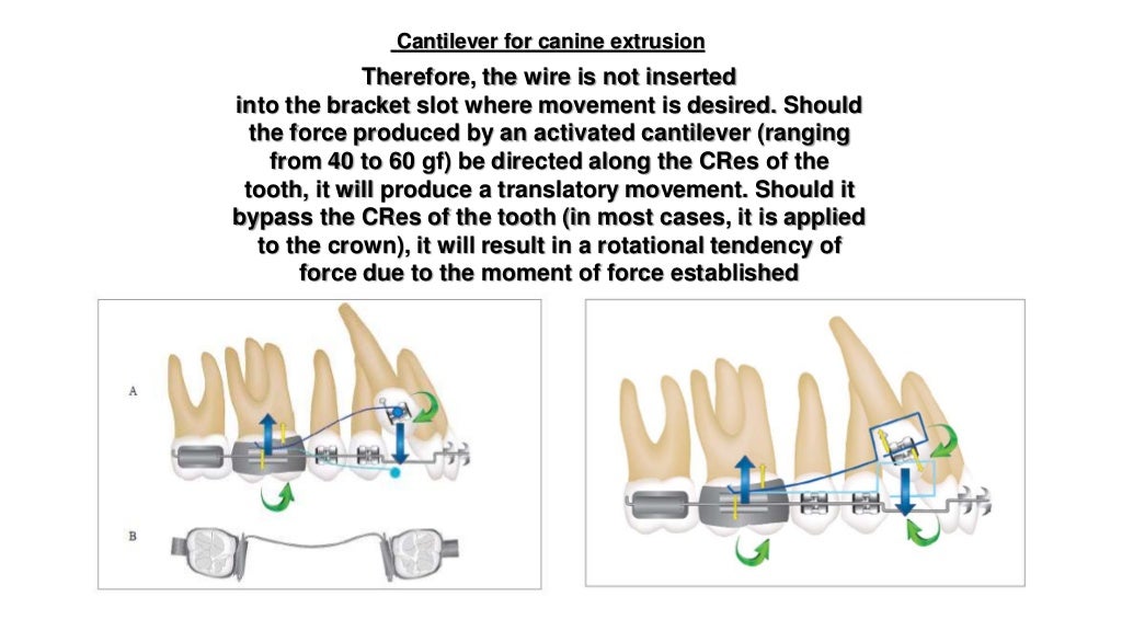 Orthodontic correction of occlusal plane canting part 1