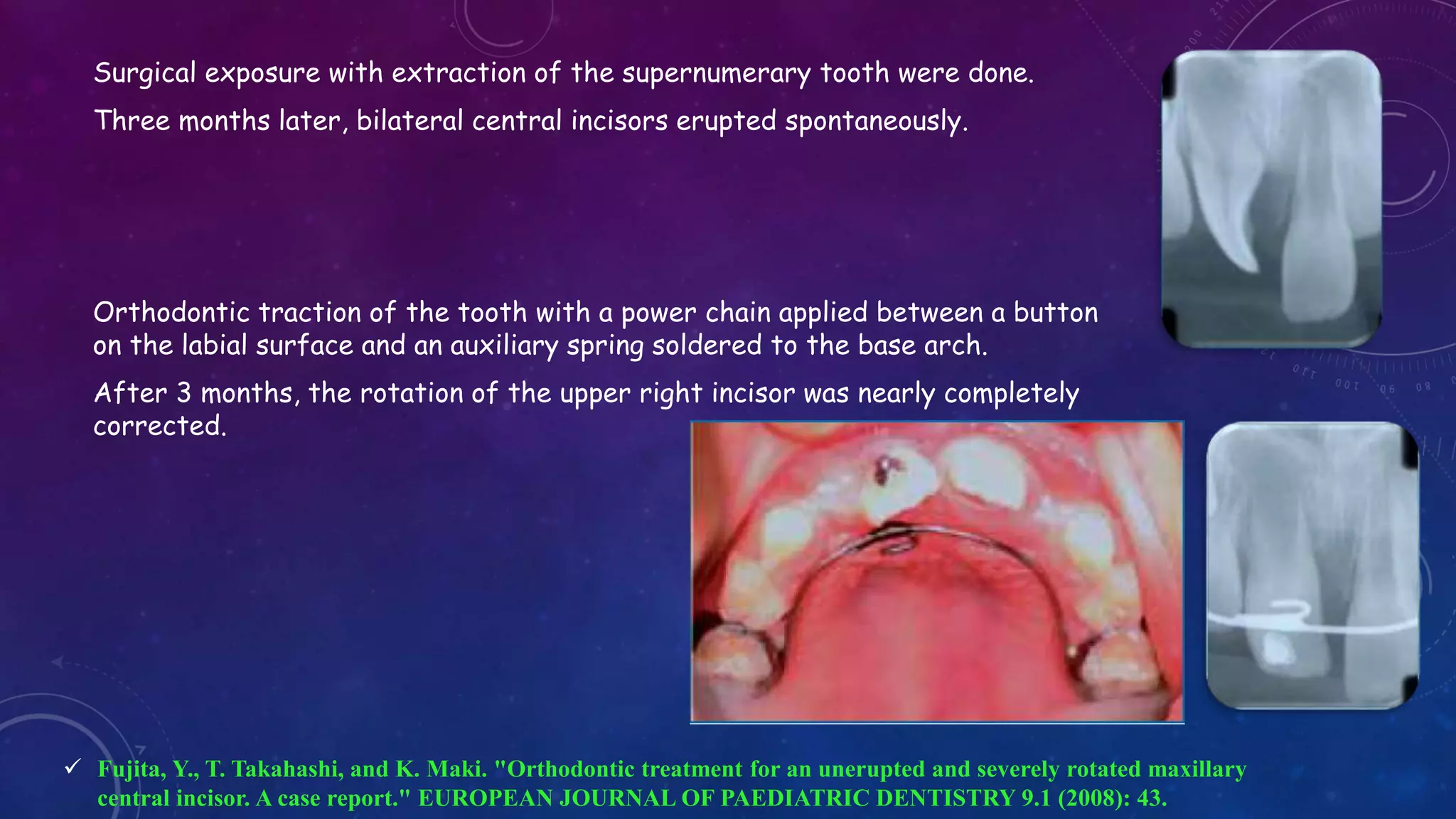 Contortion Tooth Orthodontic Correction of Rotated Teeth | PPTX