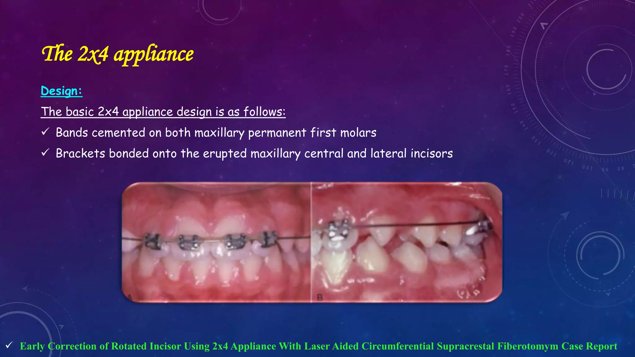 Orthodontic Correction of Rotated Teeth | PPTX