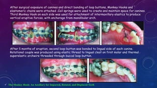 Orthodontic Correction of Rotated Teeth | PPTX