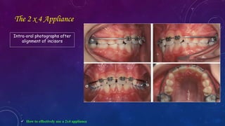 Rickinator Orthodontic Correction of Rotated Teeth | PPTX