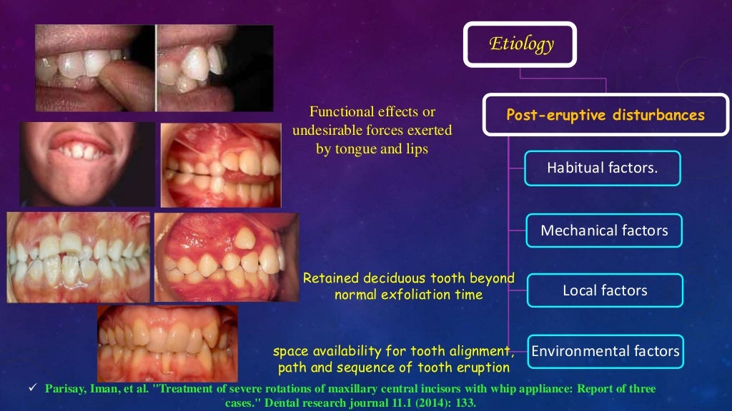 Orthodontic Correction of Rotated Teeth