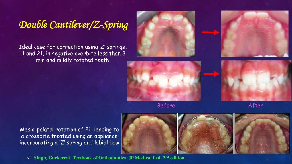 Orthodontic Correction of Rotated Teeth