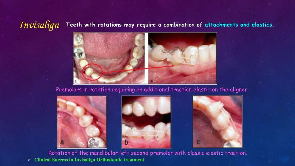 Orthodontic Correction of Rotated Teeth