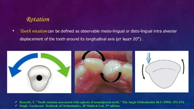 Orthodontic Correction of Rotated Teeth